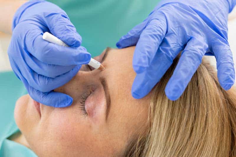 Behandlungsvorbereitung, makieren des Behandlungsareals Botox